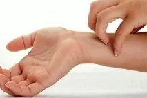 Укус мошки симптоми, лікування, як зняти набряк, народні засоби, фото - My Life укус