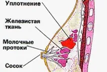 Питання-відповідь уіагноз - помірно виражена дифузно-фіброзна мастопатія уіагноз