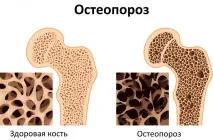 Хронічний ентерит, симптоми та лікування симптоми