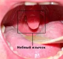 Язичок прилип до мигдалика у чому причина і як усунути дефект чому