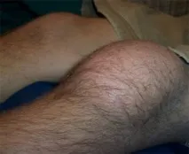 колінному