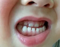 Бруксизм у дітей лікування, симптоми, причини та профілактика, ru-babyhealth симптоми