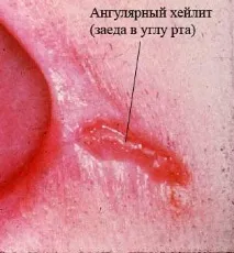 Чим лікувати і як позбутися швидко у дорослих від заїдів у куточках губ від чого вони з’являються і позбутися