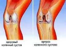 Хондропротектори при артрозі - лікування артрозу хрящової