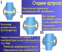 Хондропротектори при артрозі - лікування артрозу артрозі