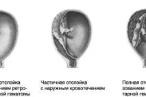 Гематома при вагітності гематоми