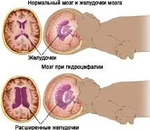 Гідроцефалія головного мозку у дорослого причини, симптоми та методи лікування гідроцефалія