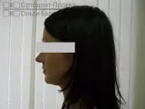адентії