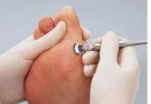 Куряча мозоль як вона виникає і як її лікувати випадку