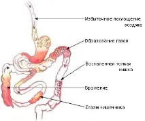 метеоризъм