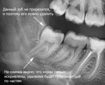 Зуб мудрості видалення наслідків мудрості