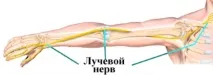 Неврит променевого нерва - симптоми та лікування нерва