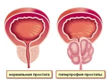 Онкологія про пухлини залоз симптоми та лікування раку та аденоми онкологія