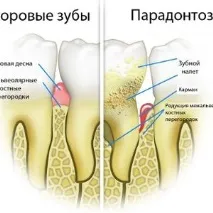 Пародонтоз причини, симптоми тапрогресування захворювання Білорусі тапрогресування