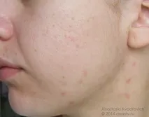 Pharmaceris T-series Bacteriostatic Cleansing Solution and Exfoliating Night Cream 5% cleansing