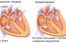 Причини низького пульсу (Брадикардія) причини