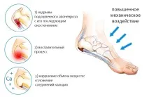 П’яткова шпора лікування в домашніх умовах домашніх