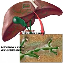 Холангіт лікування, симптоми, класифікація класифікація