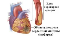 Шлуночкова тахікардія симптоми та лікування симптоми