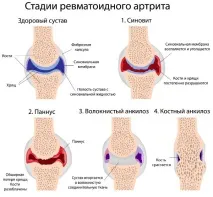 Зелений чай може вилікувати ревматоїдний артрит. вилікувати