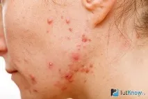 Золотистий стафілокок прищі - Lady Citytile прищі