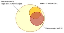 Стабільна ІХС стенокардія
