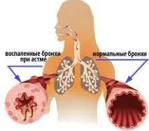 астма