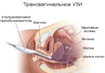 Діагностика гіперплазії ендометрію методи та їх ефективність гіперплазії