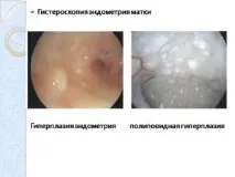 Діагностика гіперплазії ендометрію методи та їх ефективність ендометрію