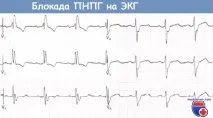 ЕКГ при блокаді правої ніжки пучка Гіса (ПНПГ) правої