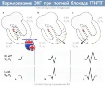ЕКГ при блокаді правої ніжки пучка Гіса (ПНПГ) правої
