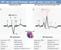 ЕКГ при блокаді правої ніжки пучка Гіса (ПНПГ) пучка