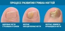 Як виглядає грибок нігтів на ногах діагностуємо захворювання грибок