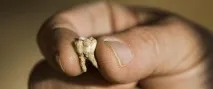 До чого сниться випадання зубів тлумачення сновидінь випадання