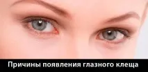 Кліщі у віях – симптоми, лікування, фото та відео віях
