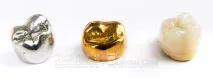 Коронка на зуб коронки