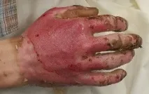 Масло обліпихи при опіках допомога