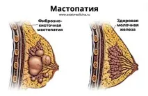 мастопатия