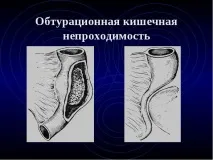 запор