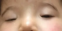 Blepharophimosis, ptosis, and epicanthus inversus syndrome (BPES) blepharophimosis
