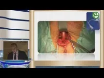 Обмежене видання реабілітація після радикальної простатектомії обмежене