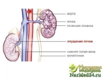 Опущення нирки головні ознаки, заходи та лікування загального характеру опущення