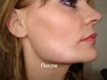 Особливості лікування гіпертрофічних рубців, поява рубців, лікування та профілактика лікування