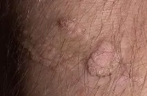 Папіломи (кондиломи) у задньому проході задньому