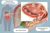 Папілома в жовчному міхурі, лікування та симптоми міхурі