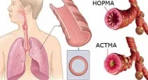 Бронхіальна астма симптоми на різних стадіях, засоби лікування астма