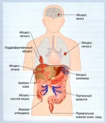 амебиаза