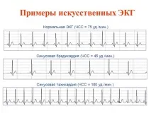 Синусова тахікардія симптоми та лікування, причини тахікардія