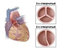 Що таке стеноз серця стеноз