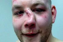 Травми носа у дітей болить